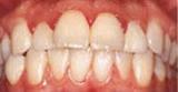 Tandkødesbetændelse - rødt og hævet